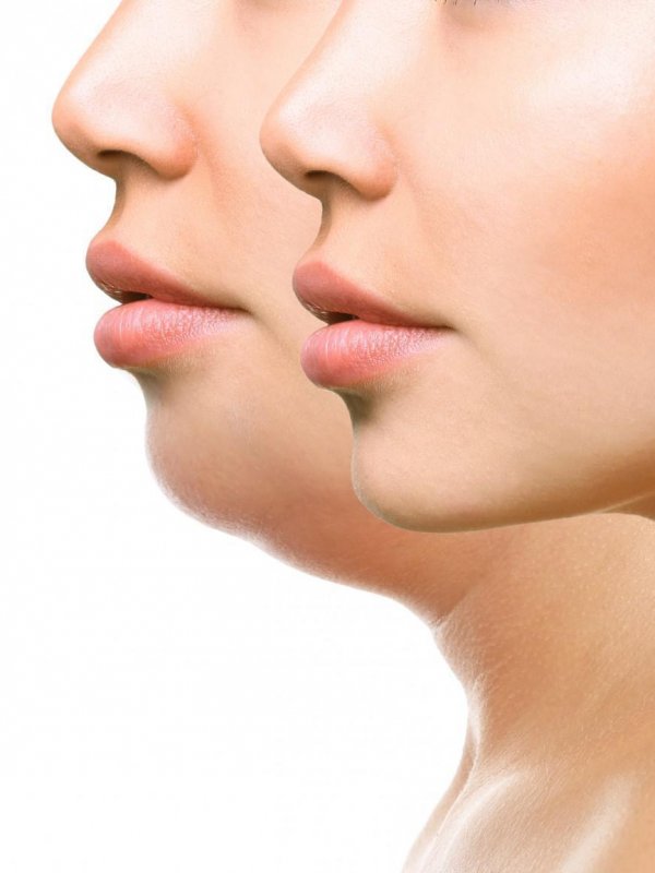 Lipoliza barbie dubla